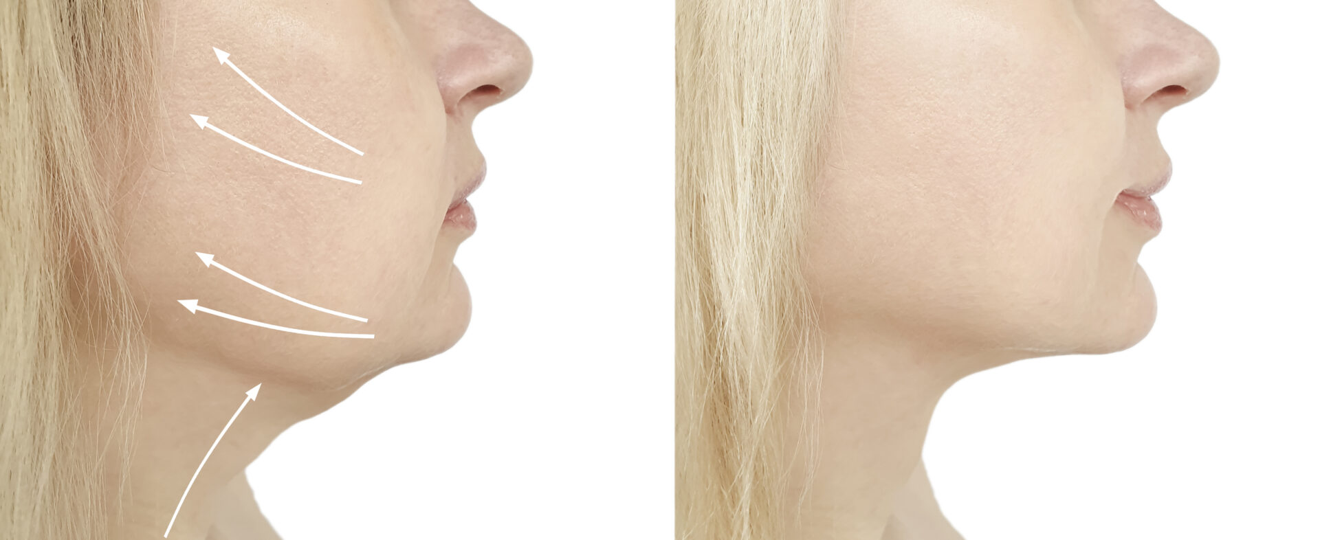 woman chin before and after procedure, retouching