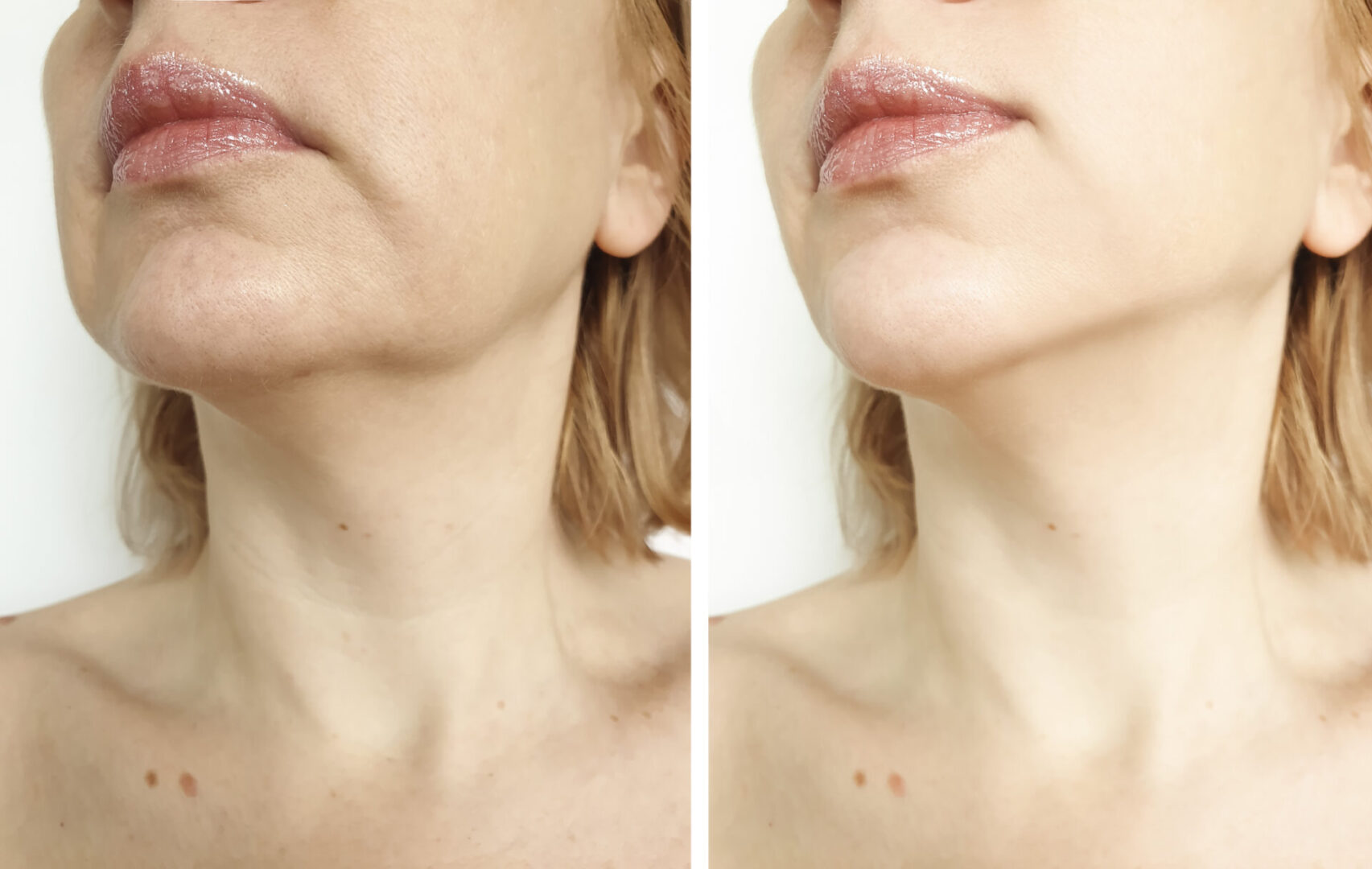 woman PDO tightening the chin before and after the procedure