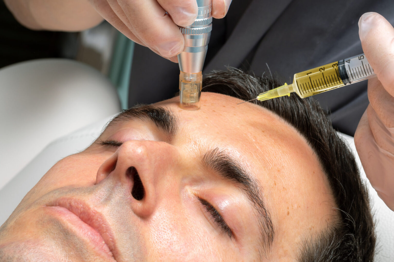 Macro close up of therapist injecting enzymes on forehead with derma pen of middle aged man.