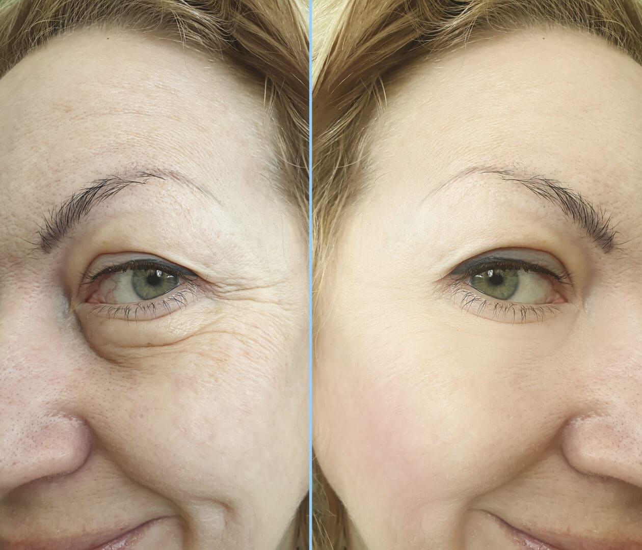 woman face wrinkles before and after collage treatment