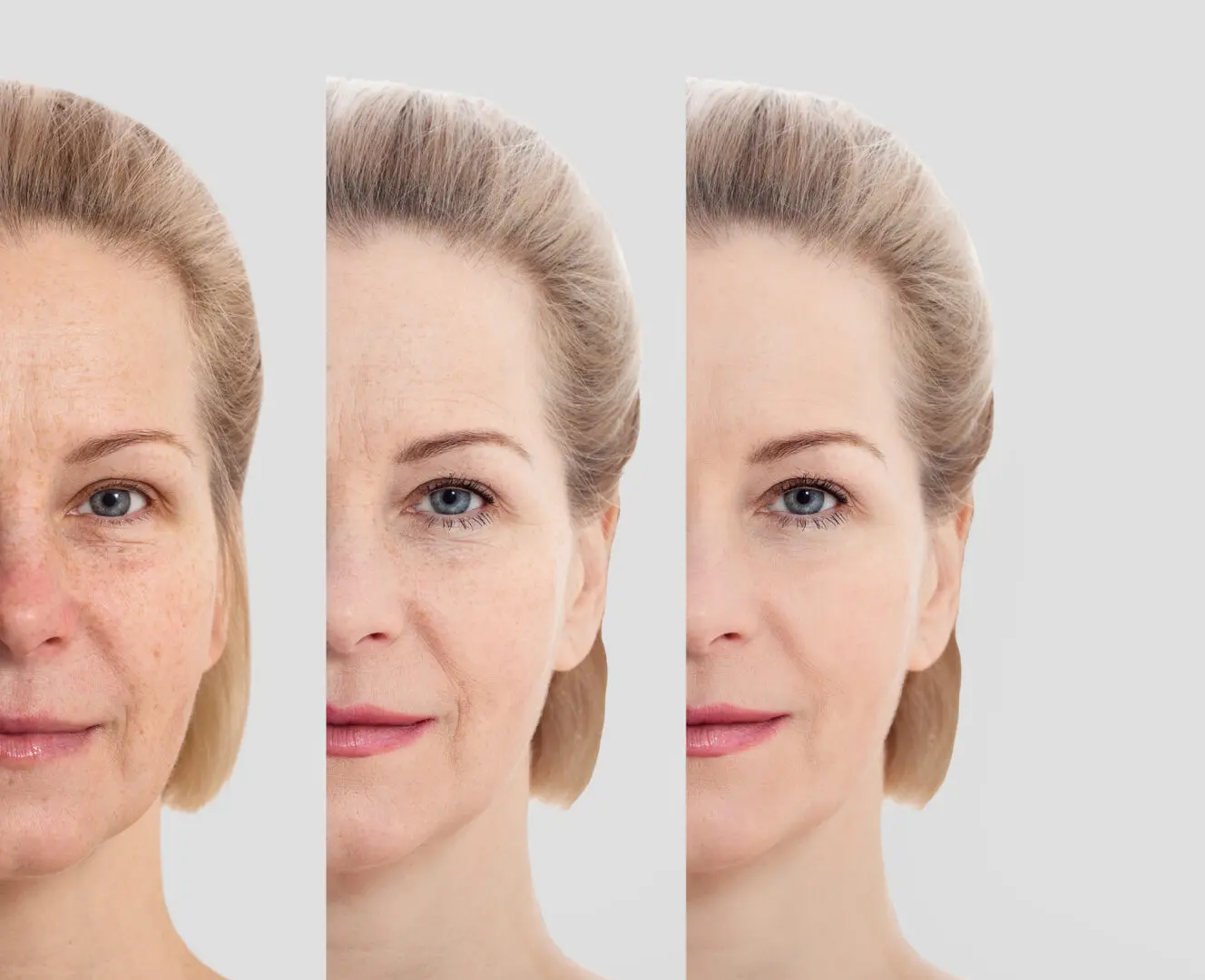 Face without makeup. Middle age close up woman face before after cosmetic. Skin care for wrinkled face. Before after anti aging facelift treatment. Facial skincare and contouring.