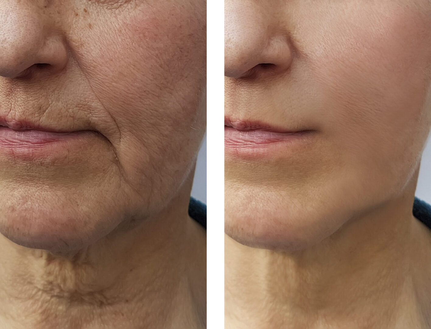 face   elderly woman wrinkles before and after